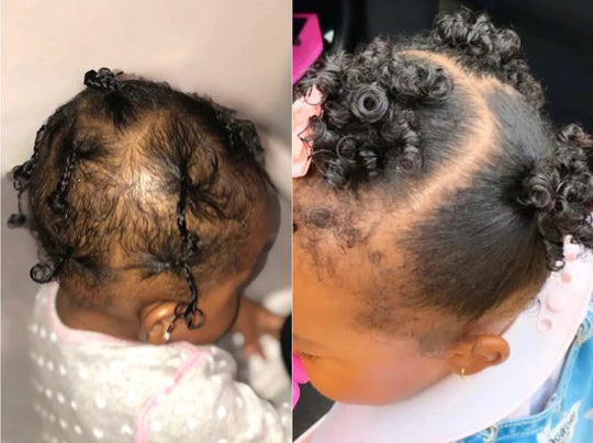 Baby/Child Hair Care System for Cradle Cap, Dry Scalp & Healthy Hair Growth 👑