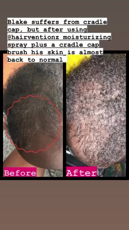 Baby/Child Hair Care System for Cradle Cap, Dry Scalp & Healthy Hair Growth 👑